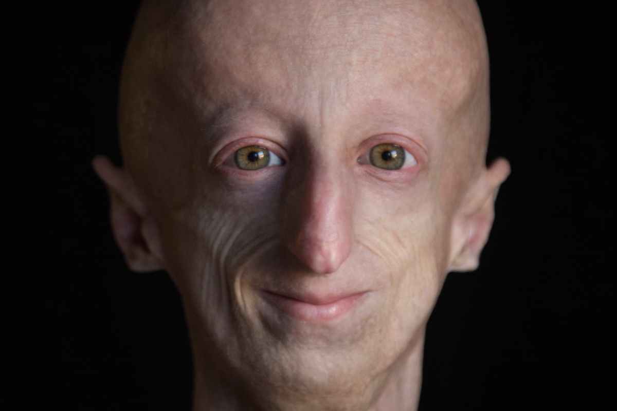 Sammy Basso progeria